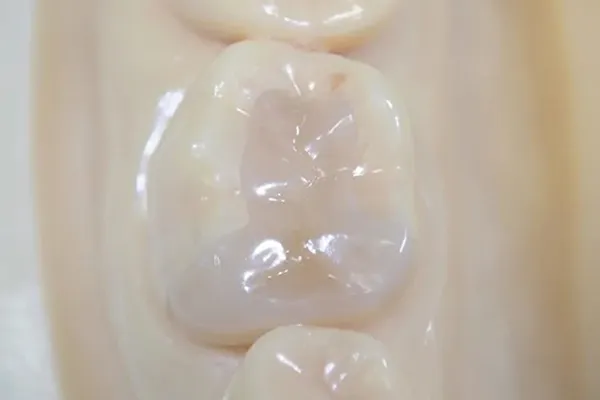 ダイレクトボンディング