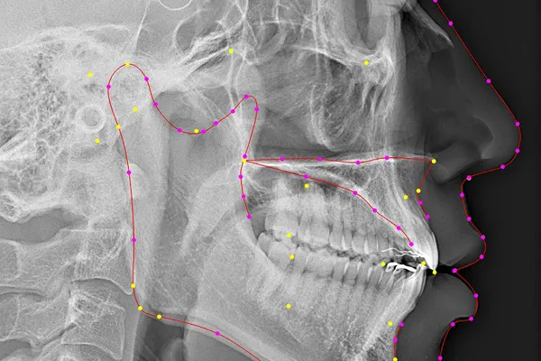 成長を見据えた矯正計画立案のためのセファロ分析