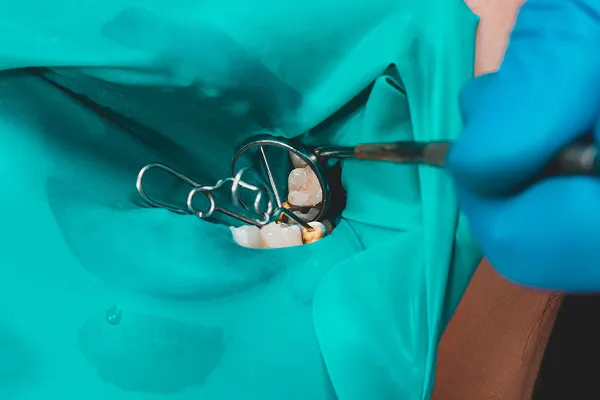 ラバーダム使用