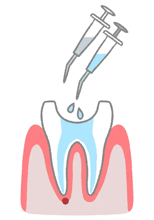 根管内の清掃・消毒