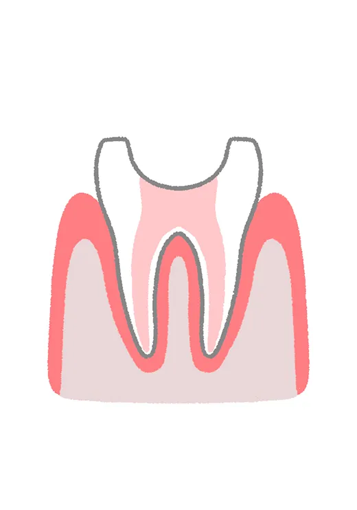 根管の乾燥と密封