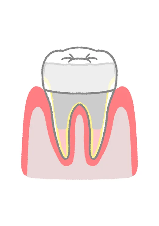 歯冠修復（クラウン・インレーなど）