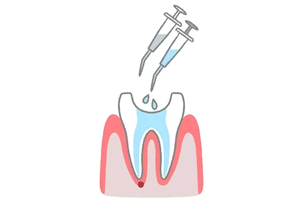 ニッケルチタンファイルによる適切な清掃・形成