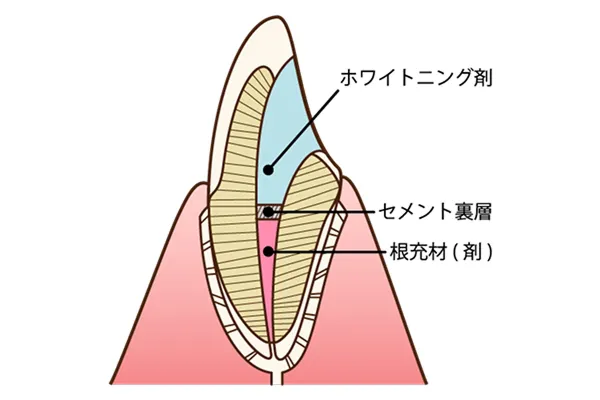 ウォーキングブリーチ